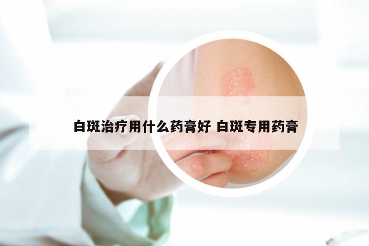 白斑治疗用什么药膏好 白斑专用药膏