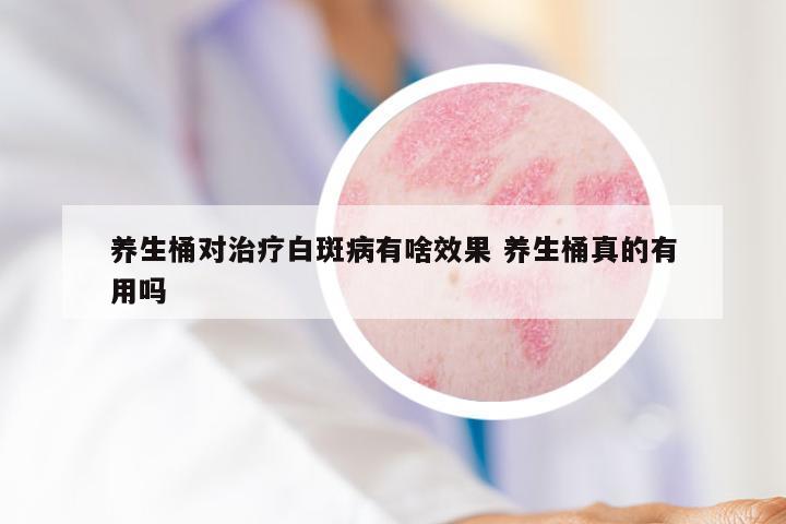 养生桶对治疗白斑病有啥效果 养生桶真的有用吗