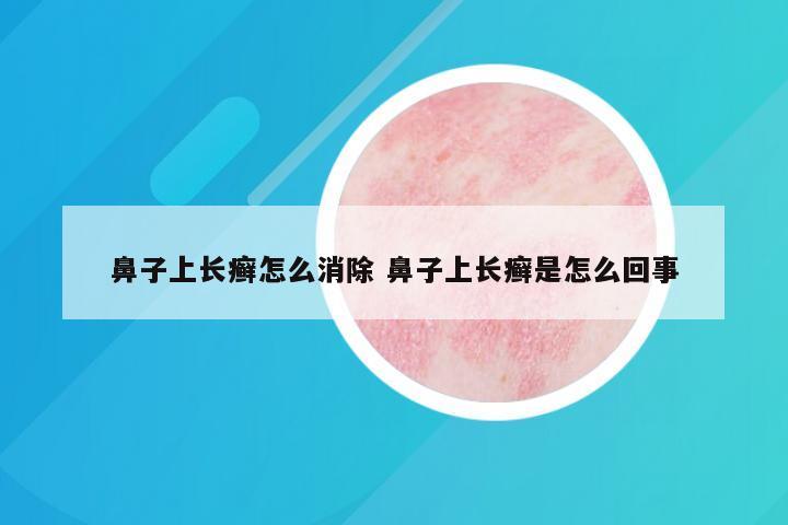 鼻子上长癣怎么消除 鼻子上长癣是怎么回事