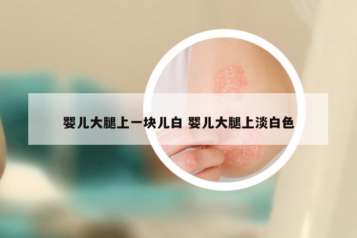 婴儿大腿上一块儿白 婴儿大腿上淡白色