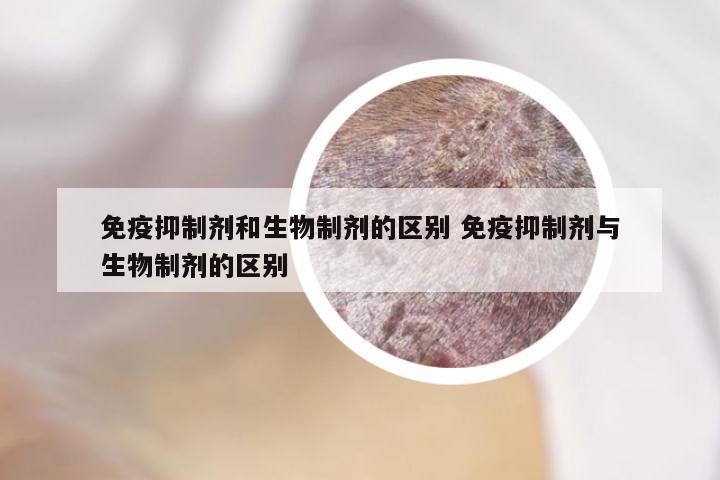 免疫抑制剂和生物制剂的区别 免疫抑制剂与生物制剂的区别