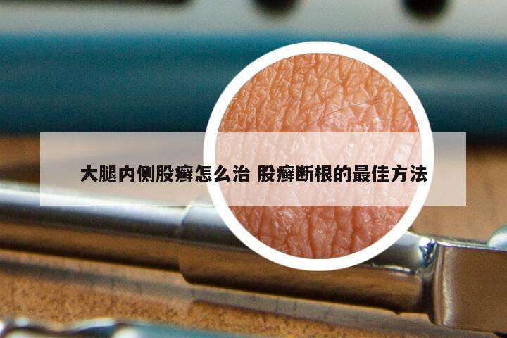 大腿内侧股癣怎么治 股癣断根的最佳方法