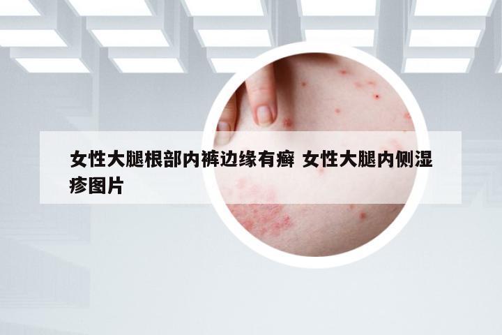 女性大腿根部内裤边缘有癣 女性大腿内侧湿疹图片