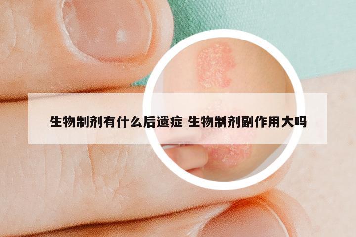 生物制剂有什么后遗症 生物制剂副作用大吗