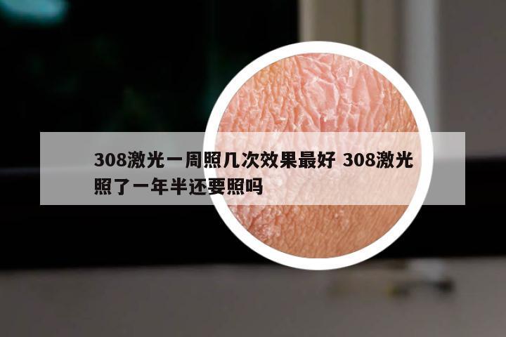 308激光一周照几次效果最好 308激光照了一年半还要照吗