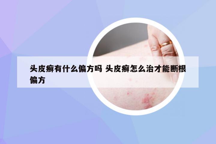 头皮癣有什么偏方吗 头皮癣怎么治才能断根偏方