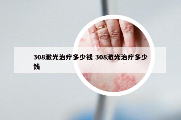 308激光治疗多少钱 308激光治疗多少钱