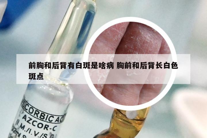 前胸和后背有白斑是啥病 胸前和后背长白色斑点