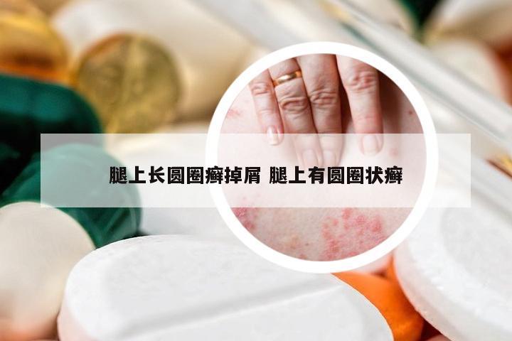 腿上长圆圈癣掉屑 腿上有圆圈状癣