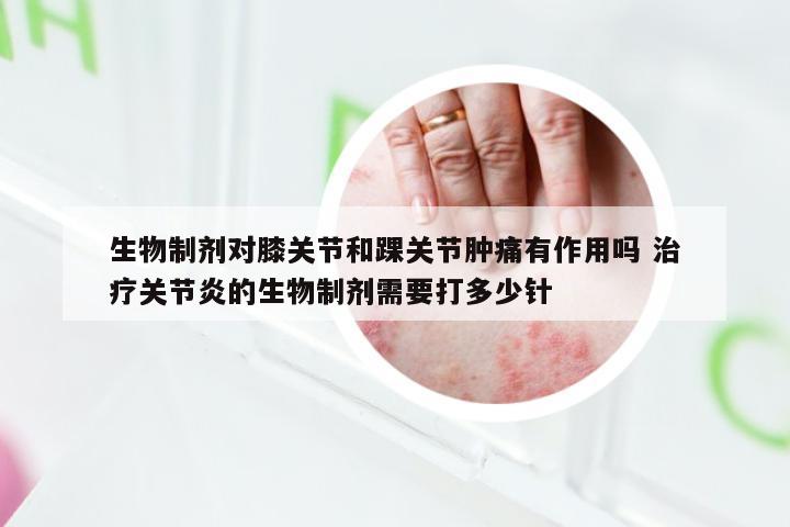 生物制剂对膝关节和踝关节肿痛有作用吗 治疗关节炎的生物制剂需要打多少针