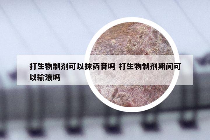 打生物制剂可以抹药膏吗 打生物制剂期间可以输液吗