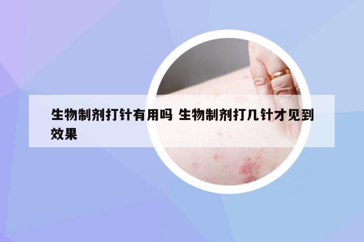 生物制剂打针有用吗 生物制剂打几针才见到效果