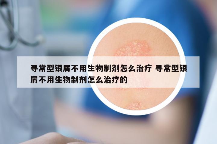 寻常型银屑不用生物制剂怎么治疗 寻常型银屑不用生物制剂怎么治疗的