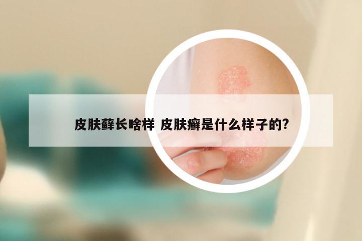 皮肤藓长啥样 皮肤癣是什么样子的?