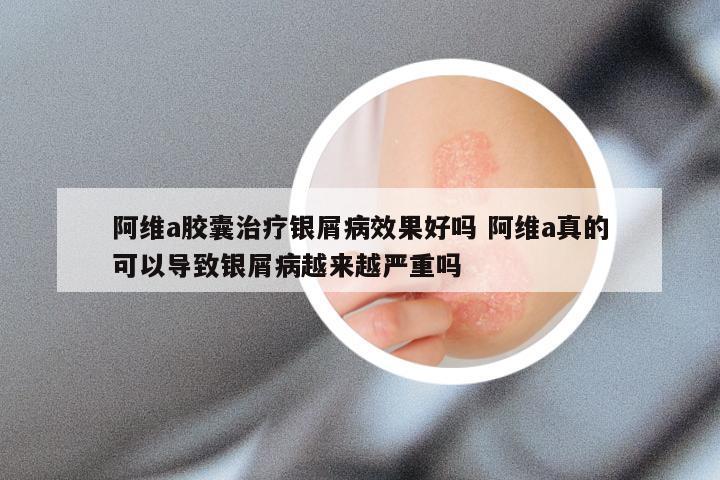 阿维a胶囊治疗银屑病效果好吗 阿维a真的可以导致银屑病越来越严重吗