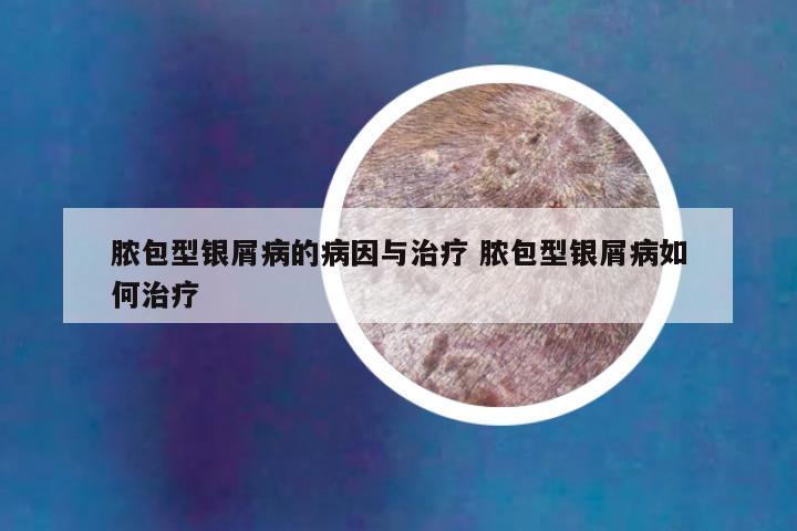 脓包型银屑病的病因与治疗 脓包型银屑病如何治疗