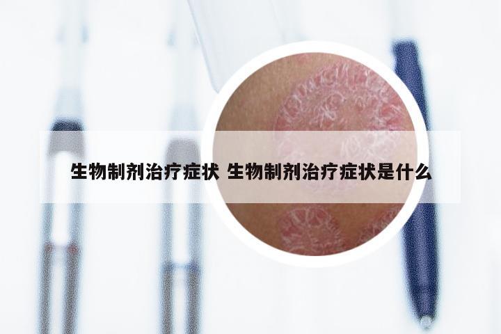 生物制剂治疗症状 生物制剂治疗症状是什么