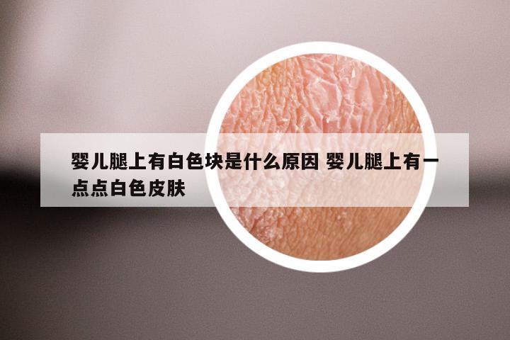 婴儿腿上有白色块是什么原因 婴儿腿上有一点点白色皮肤