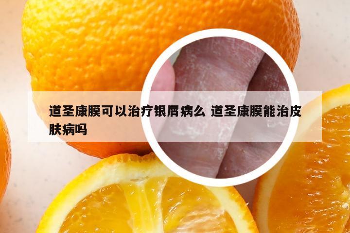 道圣康膜可以治疗银屑病么 道圣康膜能治皮肤病吗