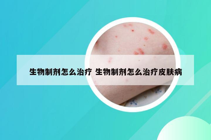 生物制剂怎么治疗 生物制剂怎么治疗皮肤病