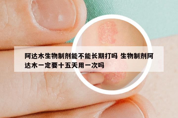 阿达木生物制剂能不能长期打吗 生物制剂阿达木一定要十五天用一次吗