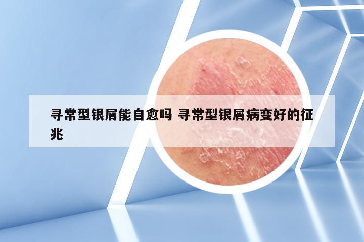 寻常型银屑能自愈吗 寻常型银屑病变好的征兆