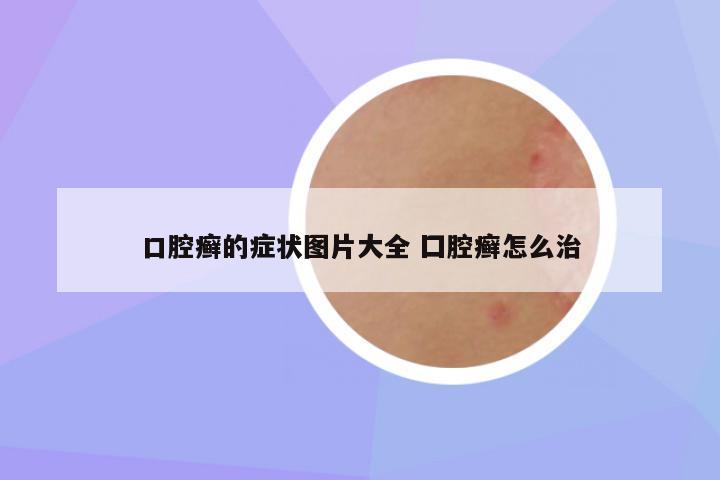 口腔癣的症状图片大全 囗腔癣怎么治