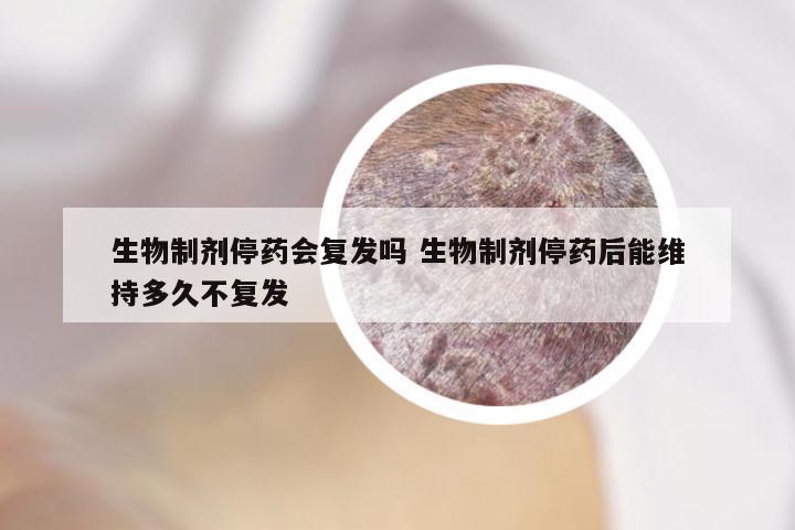 生物制剂停药会复发吗 生物制剂停药后能维持多久不复发