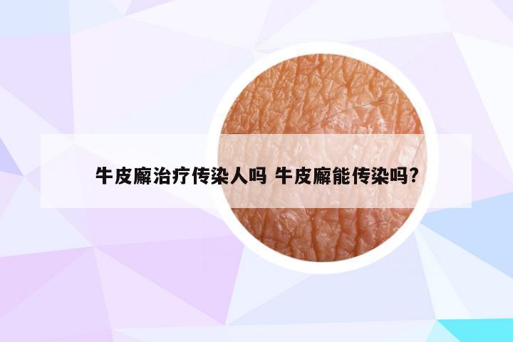 牛皮廨治疗传染人吗 牛皮廨能传染吗?