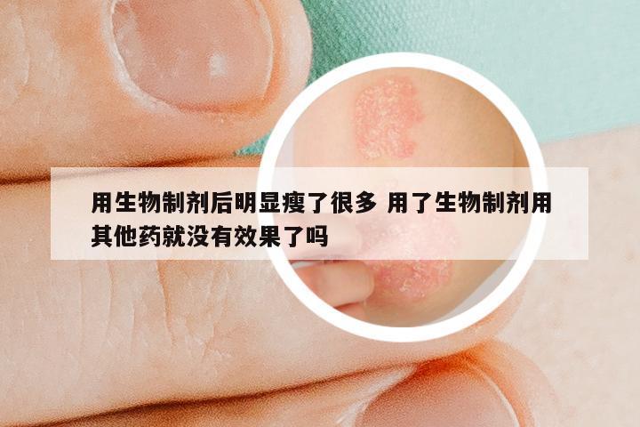 用生物制剂后明显瘦了很多 用了生物制剂用其他药就没有效果了吗