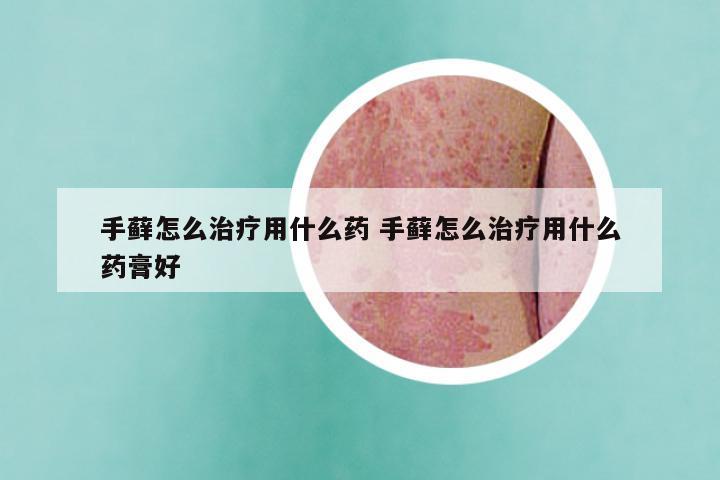 手藓怎么治疗用什么药 手藓怎么治疗用什么药膏好