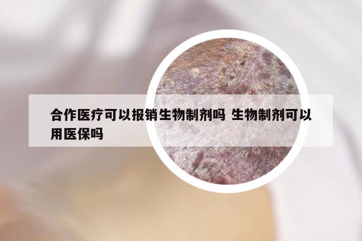 合作医疗可以报销生物制剂吗 生物制剂可以用医保吗