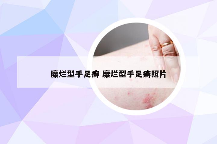 糜烂型手足癣 糜烂型手足癣照片