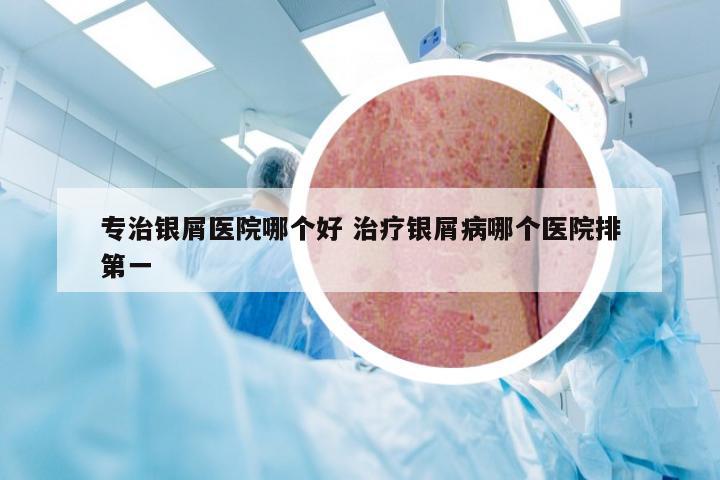 专治银屑医院哪个好 治疗银屑病哪个医院排第一