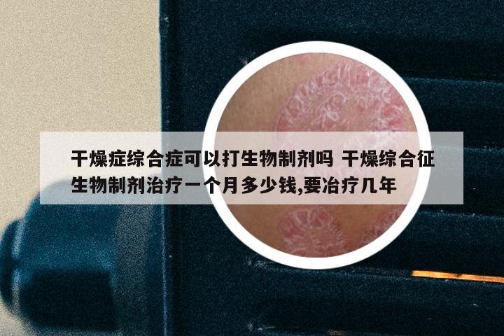 干燥症综合症可以打生物制剂吗 干燥综合征生物制剂治疗一个月多少钱,要冶疗几年