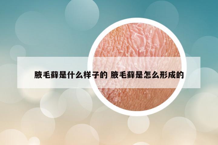 腋毛藓是什么样子的 腋毛藓是怎么形成的