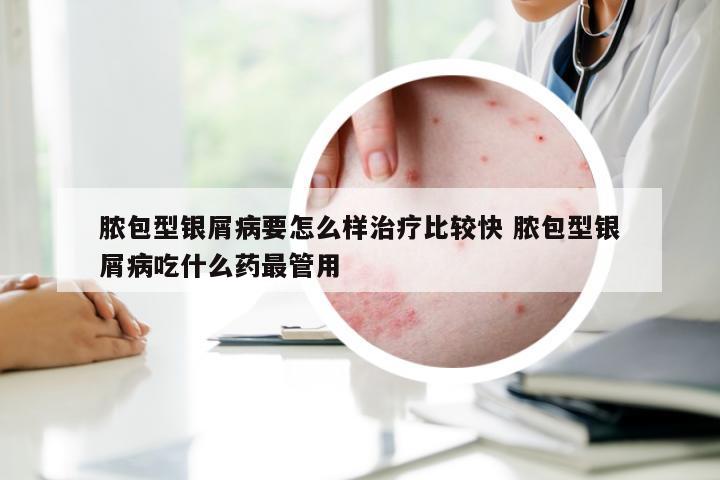 脓包型银屑病要怎么样治疗比较快 脓包型银屑病吃什么药最管用