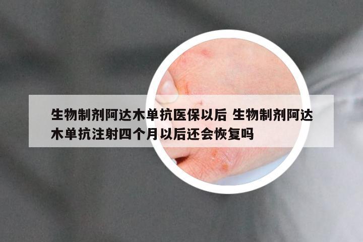 生物制剂阿达木单抗医保以后 生物制剂阿达木单抗注射四个月以后还会恢复吗