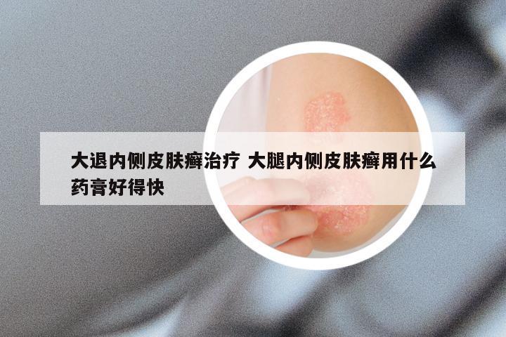 大退内侧皮肤癣治疗 大腿内侧皮肤癣用什么药膏好得快