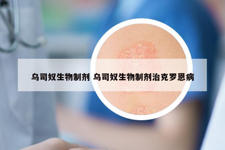 乌司奴生物制剂 乌司奴生物制剂治克罗恩病