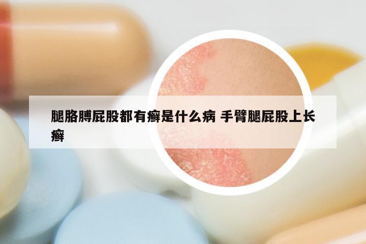 腿胳膊屁股都有癣是什么病 手臂腿屁股上长癣