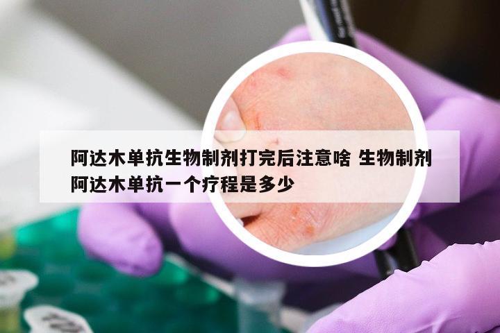 阿达木单抗生物制剂打完后注意啥 生物制剂阿达木单抗一个疗程是多少