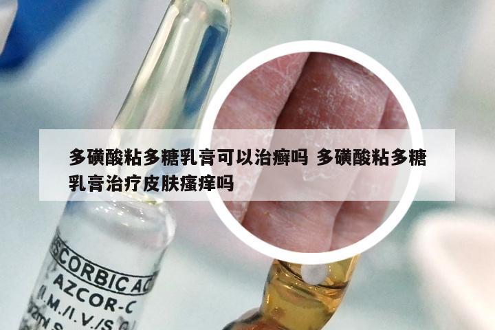 多磺酸粘多糖乳膏可以治癣吗 多磺酸粘多糖乳膏治疗皮肤瘙痒吗