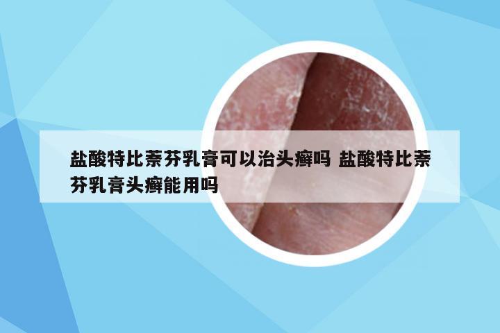 盐酸特比萘芬乳膏可以治头癣吗 盐酸特比萘芬乳膏头癣能用吗