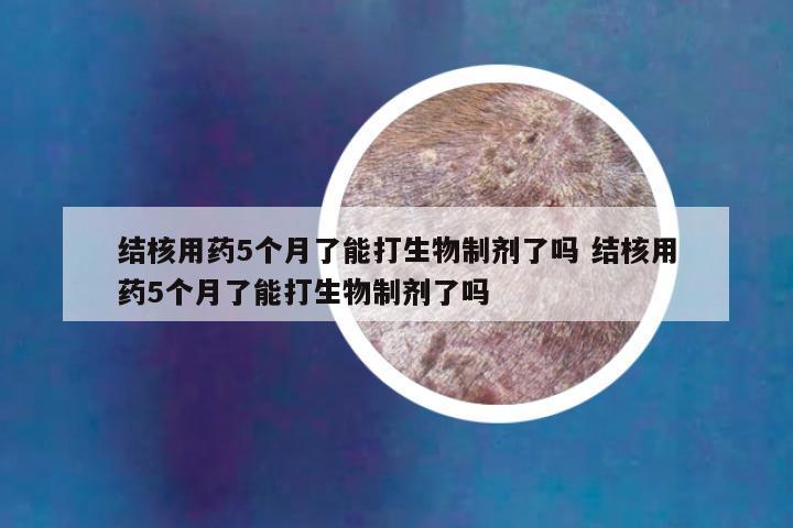 结核用药5个月了能打生物制剂了吗 结核用药5个月了能打生物制剂了吗