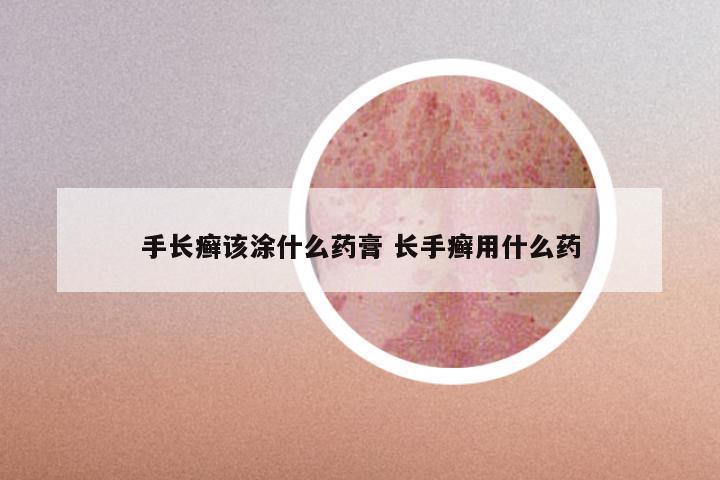 手长癣该涂什么药膏 长手癣用什么药