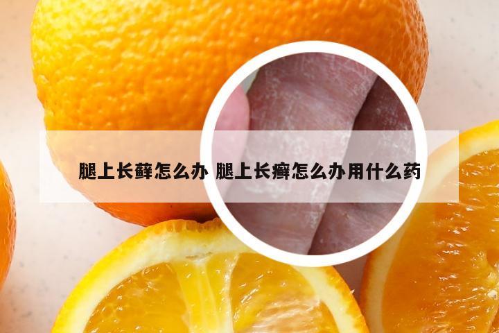 腿上长藓怎么办 腿上长癣怎么办用什么药