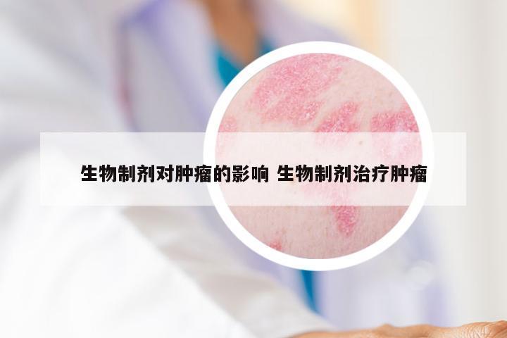 生物制剂对肿瘤的影响 生物制剂治疗肿瘤