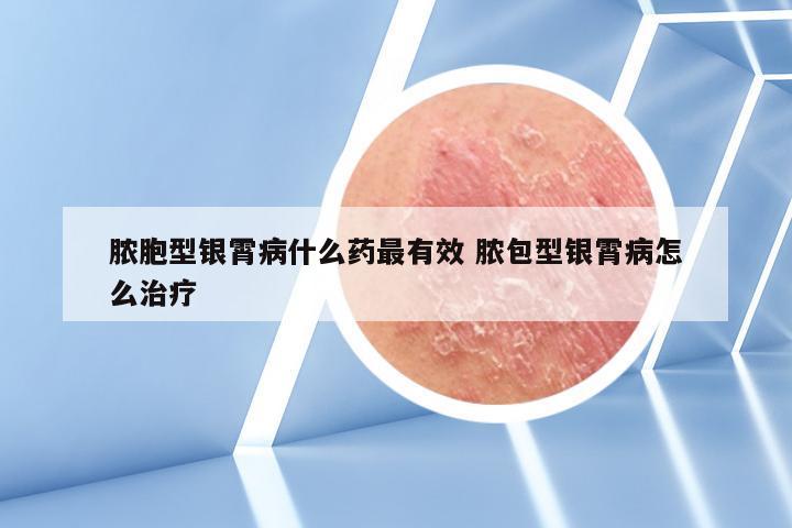 脓胞型银霄病什么药最有效 脓包型银霄病怎么治疗