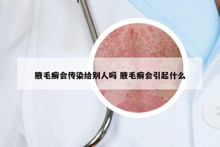 腋毛癣会传染给别人吗 腋毛癣会引起什么